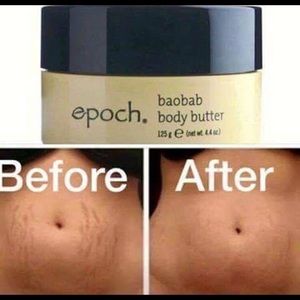 Great for struggling with stretch marks